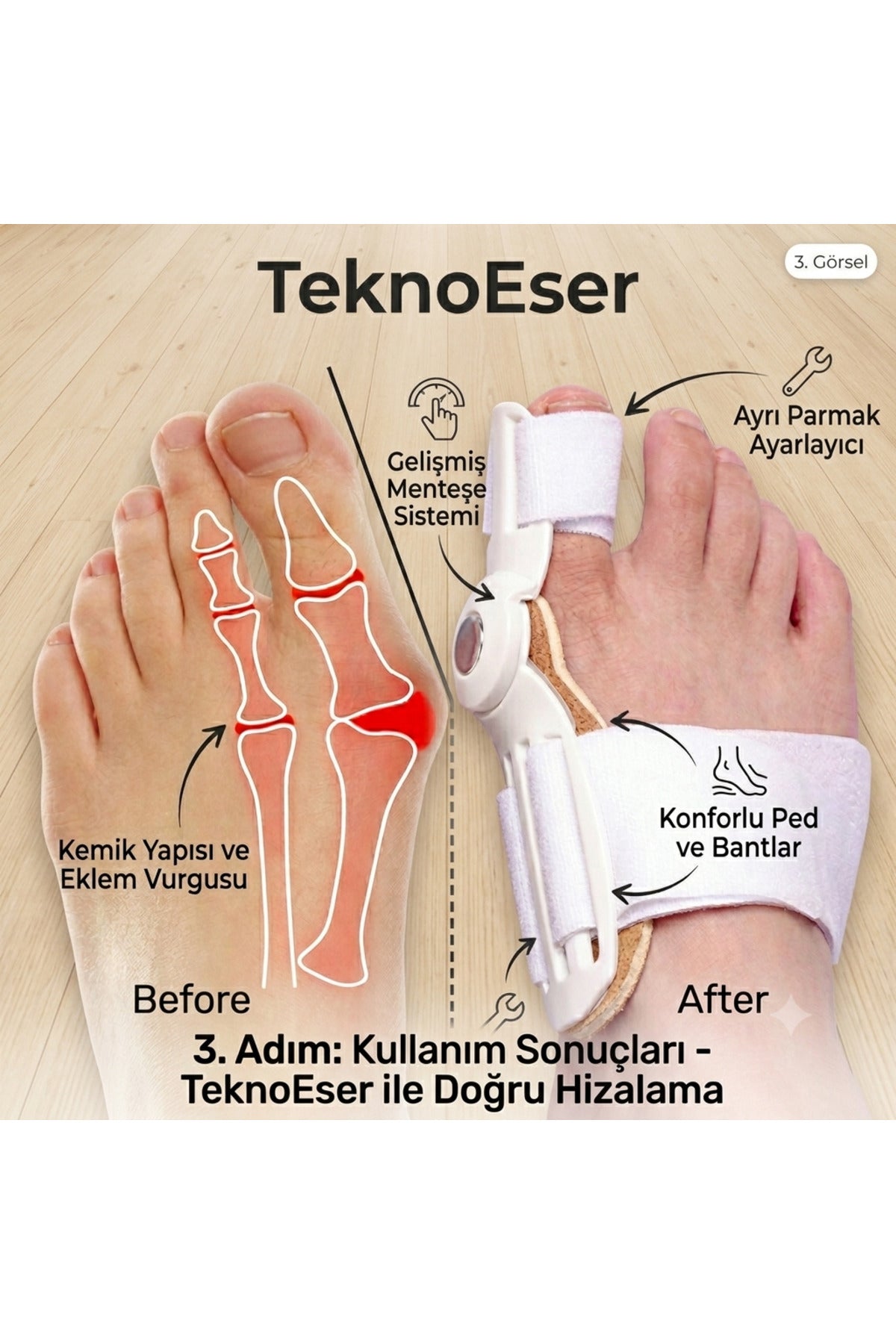 Hallux Valgus Düzeltici - Baş Parmak Eğriliği Ortezi Gece Gündüz Kullanım Ayak Koruyucu