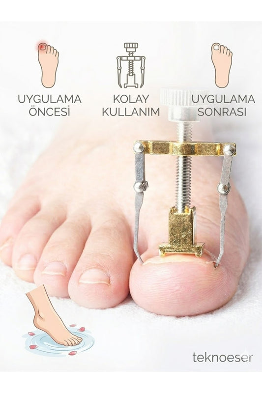 Batık Tırnak Düzeltici Seti – Ayak Bakımı Pedikür Aleti Tırnak Düzleştirici Profesyonel